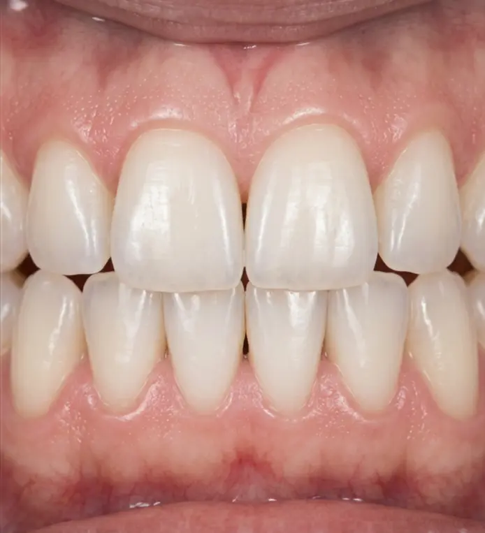 Після процедури